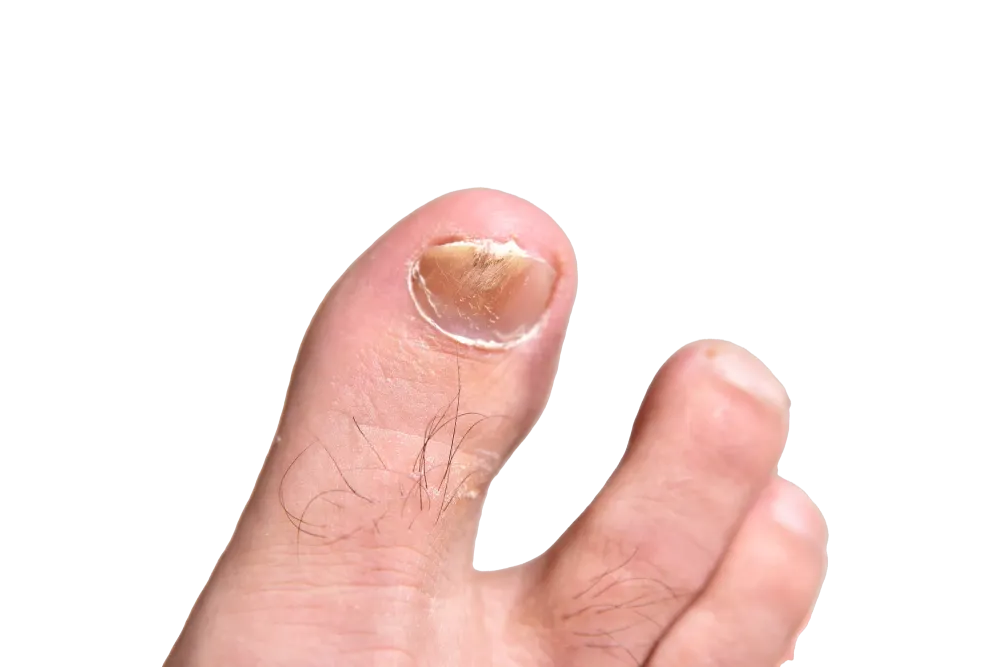 ongle mycosé près de Hyères